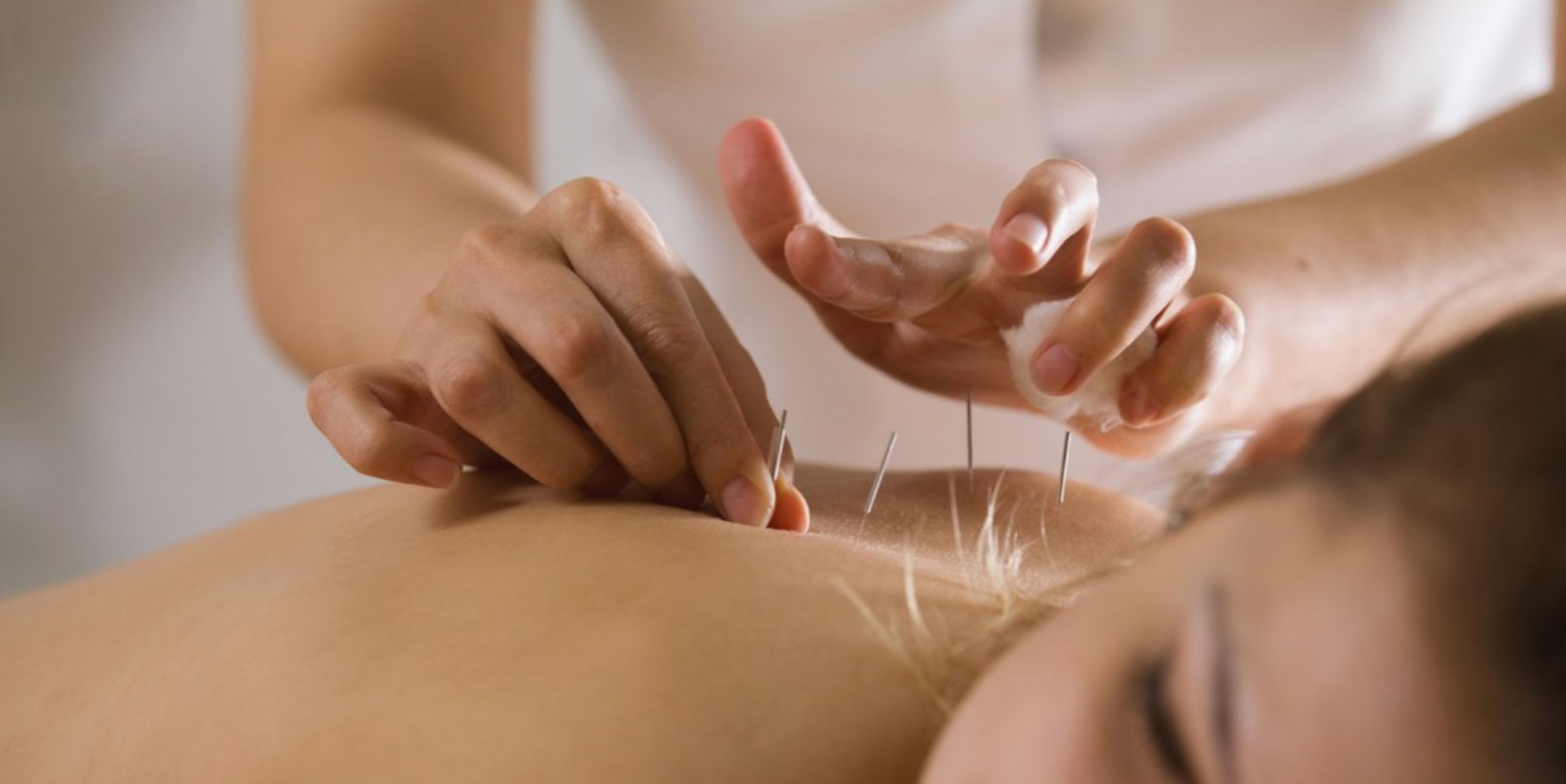 What You Need to Know About Dry Needling with Electrical Stimulation, Orthopedic Blog